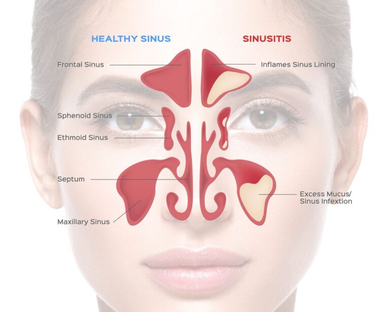 Understanding Sinusitis: Symptoms, Causes, and Treatment